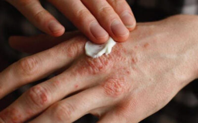 Leprás megbetegedéseket regisztráltak szomszédainknál