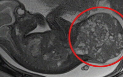 800 grammos daganatot távolítottak el egy csecsemő testéből