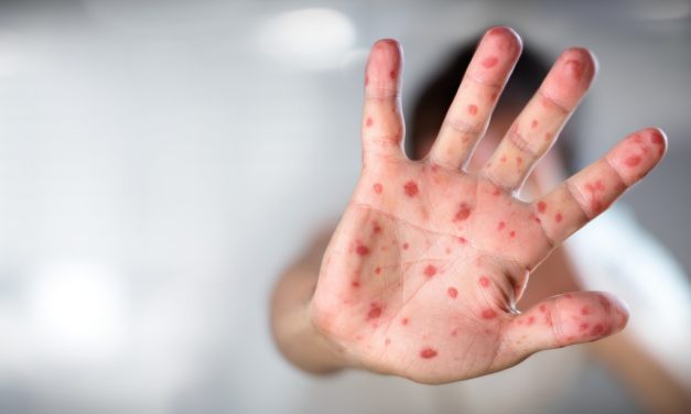 Ebben a városban már kanyarójárvány van