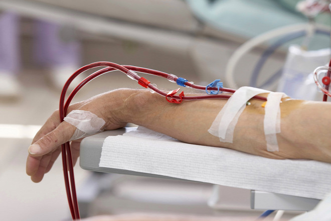 Vajdaságban 170 beteg vár veseátütetésre