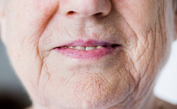 Elvesztette akcentusát szélütése után egy nő