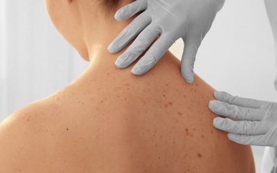 Két nap alatt tizenegy bőrrákot diagnosztizáltak Temerinben