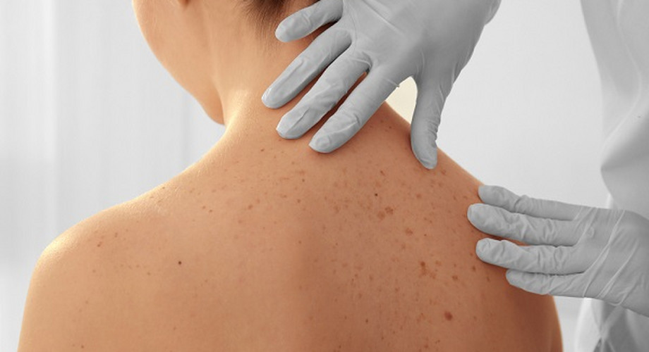 A mesterséges intelligencia jobban felismeri a bőrrákot, mint az ember