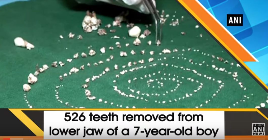 Ötszázhuszonhat fogat vettek ki egy hétéves kisfiú szájából (VIDEÓ)