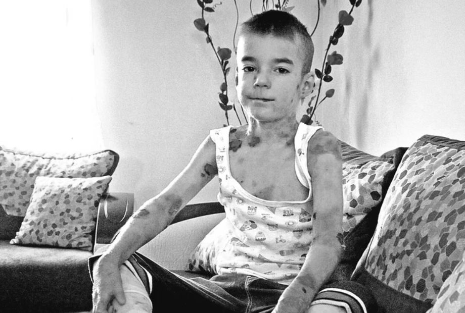 Szerbia gyászol: Elhunyt a pillangógyerek