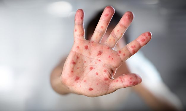 Van olyan város, ahol már kihirdették a kanyarójárványt