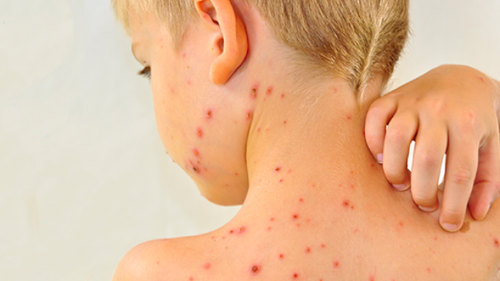 Növekszik a kanyarós fertőzöttek száma