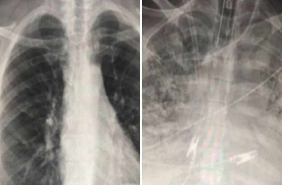 84 százalékkal nőhet a rákos megbetegedések száma a férfiak között 2050-re