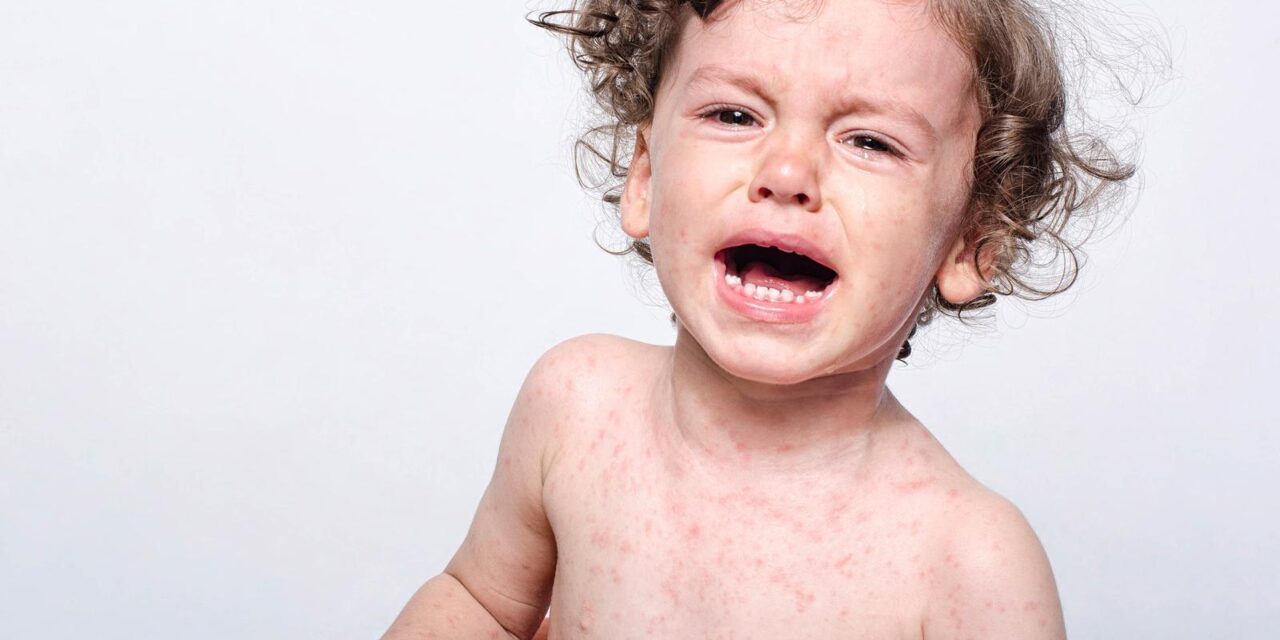 Harmincszorosára nőttek a kanyarós megbetegedések Európában