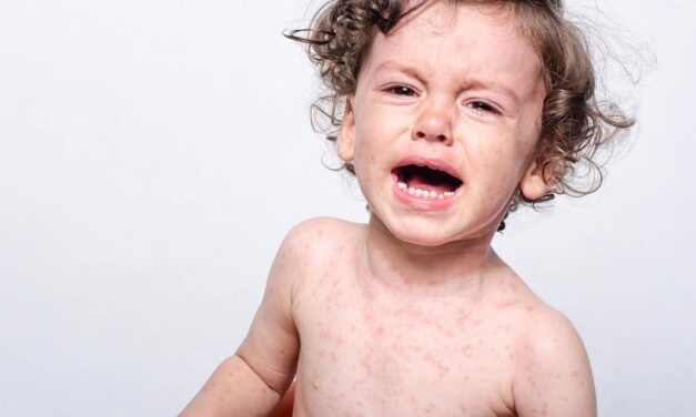 Nem az a kérdés, hogy lesz-e kanyarójárvány, hanem az, hogy mikor?