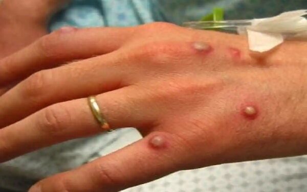 Európában is felütötte fejét a majomhimlő