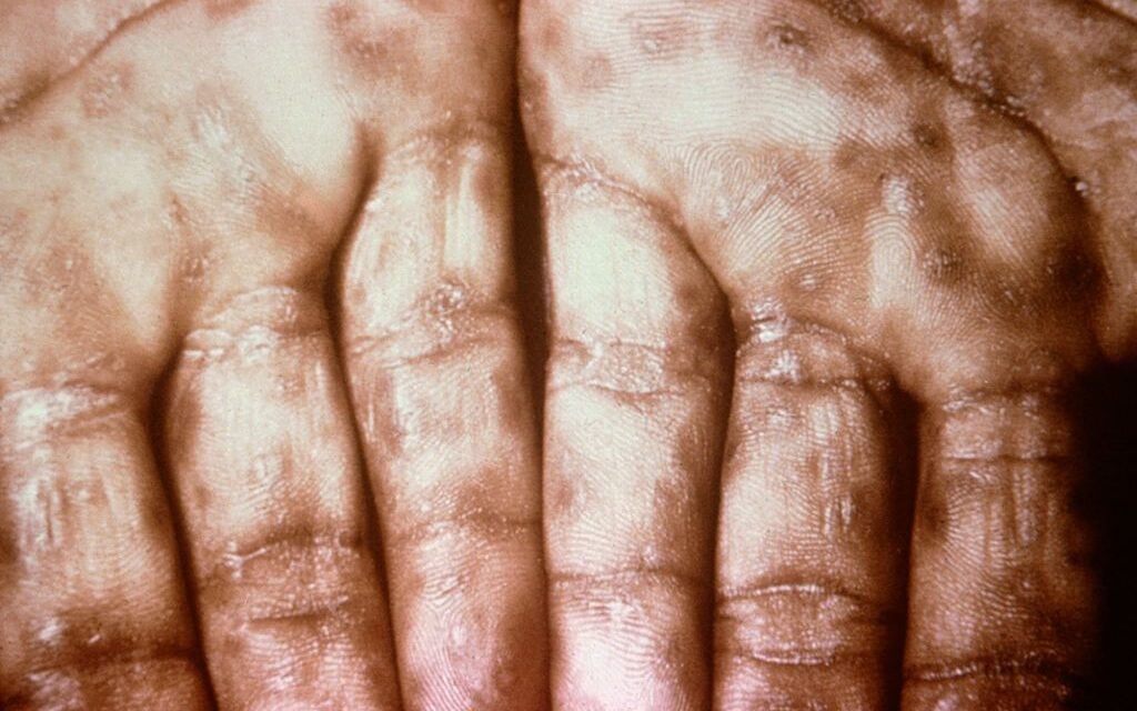 Belgrádban egyre több a szifiliszes beteg