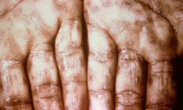 Belgrádban egyre több a szifiliszes beteg