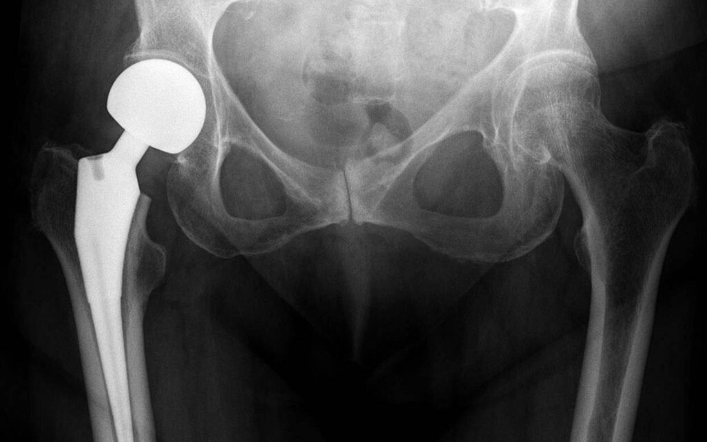 Csípő- vagy térdprotézis beültetésre vár? Itt az egészségbiztosító legújabb felhívása!