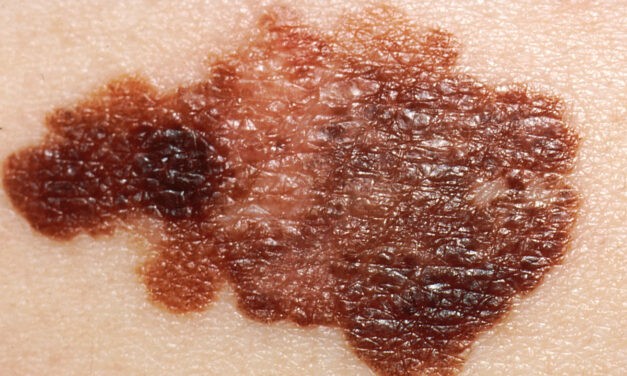 Két évtized alatt megduplázódott a bőrrákos esetek száma