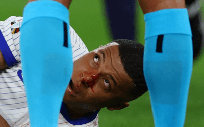 Eltörött Mbappé orra, de nem kell megműteni