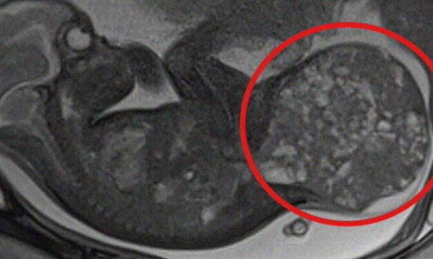 800 grammos daganatot távolítottak el egy csecsemő testéből
