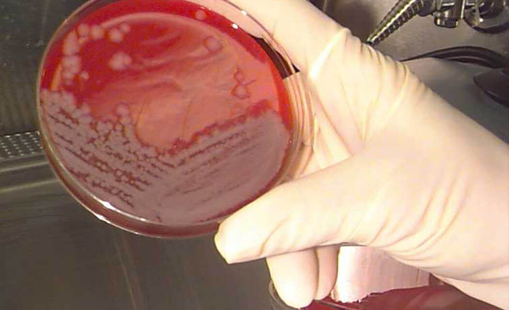 Lépfenét diagnosztizáltak egy páciensnél Magyarországon