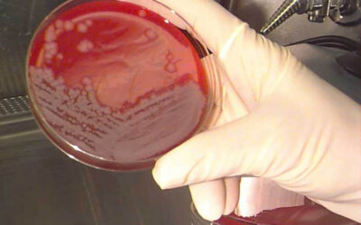 Lépfenét diagnosztizáltak egy páciensnél Magyarországon