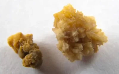 Drágakőnek hitték, de vesekő volt a peches betörők zsákmánya