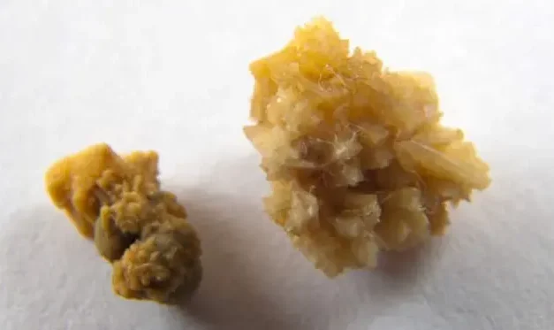 Drágakőnek hitték, de vesekő volt a peches betörők zsákmánya