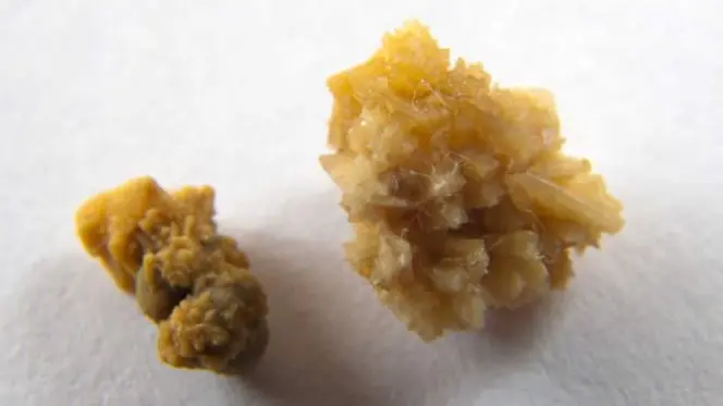 Drágakőnek hitték, de vesekő volt a peches betörők zsákmánya